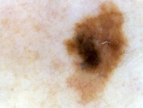 Dermoscopy: black blotch in melanoma