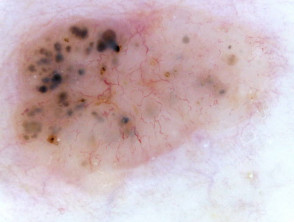 Branching serpentine vessels and blue-grey ovoid nests in pigmented basal cell carcinoma dermoscopy