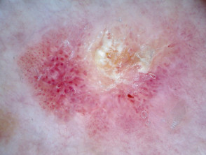 Intraepidermal carcinoma, polarised dermoscopy view