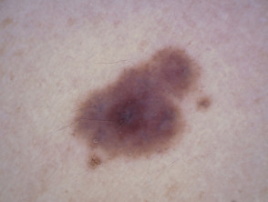 Naevus, skin type 4 dermoscopy 4