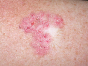 Superficial basal cell carcinoma, trunk