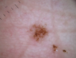Dermoscopy of acral lentiginous melanoma