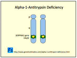 Alpha-1-antitrypsin deficiency genetics 