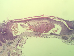 Angiokeratoma pathology