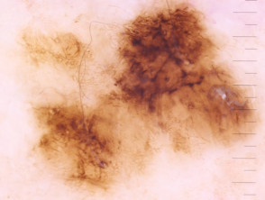 Angulated lines seen on dermoscopy of a melanoma