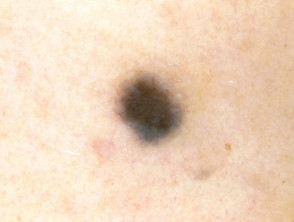 Blue naevus, skin type 3, dermoscopy 2