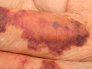 Ecchymoses associated with skin atrophy