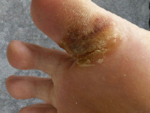 Hand-foot syndrome due to sorafenib