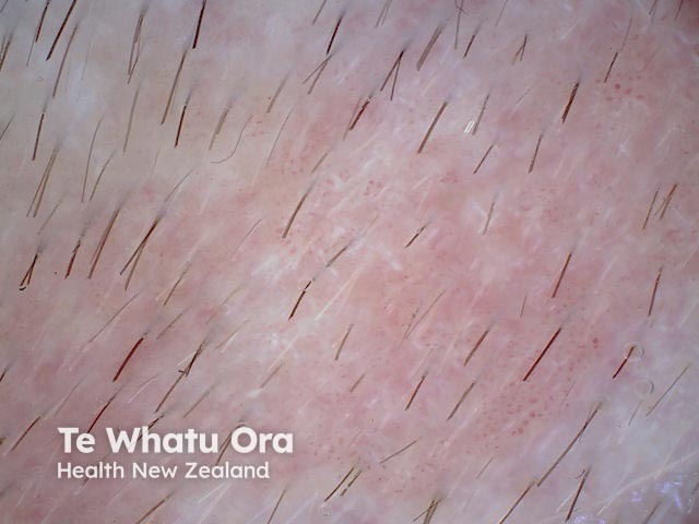 Intraepidermal carcinoma dermoscopy