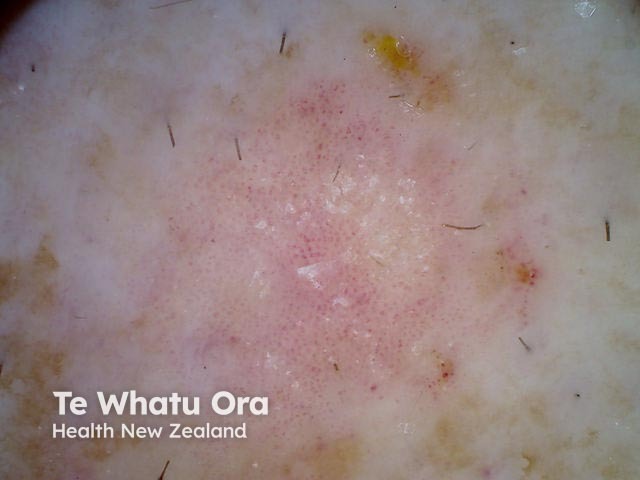 Intraepidermal carcinoma dermoscopy