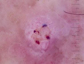Invasive squamous cell carcinoma, keratoacanthoma type, nonpolarised dermoscopy view