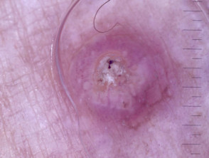 Invasive squamous cell carcinoma nonpolarised dermoscopy view