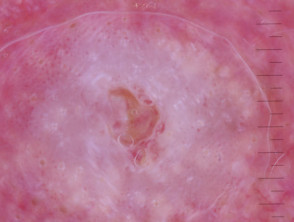 Invasive squamous cell carcinoma polarised dermoscopy view