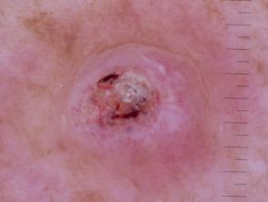 Keratoacanthoma nonpolarised dermoscopy view