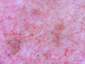 Concentric circles (red arrows) seen in dermoscopy of lentigo maligna