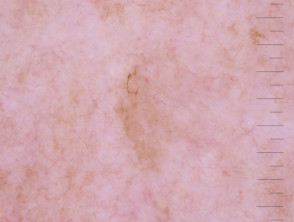 Angulated lines in dermoscopy of melanoma
