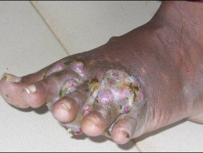 Mycetoma foot