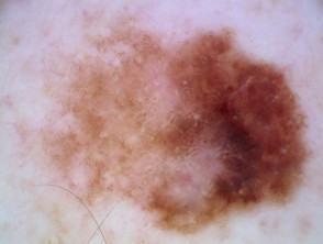 Melanoma in situ in collision with a benign dermal naevus