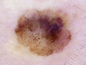 Superficial spreading melanoma in situ arising from an atypical naevus