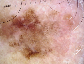 Invasive melanoma