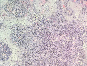 Pseudocarcinomatous hyperplasia in anaplastic large cell lymphoma