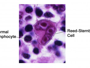Reed Sternberg lymphocyte nci vol 7172 300