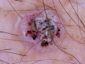 Squamous cell carcinoma, keratoacanthoma type, nonpolarised dermoscopy view