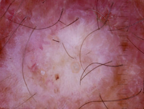 Squamous cell carcinoma, keratoacanthoma type, polarised dermoscopy view