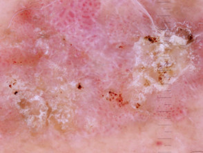 Squamous cell carcinoma polarised dermoscopy view