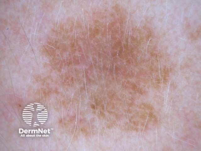 Dermoscopy of a solar lentigo