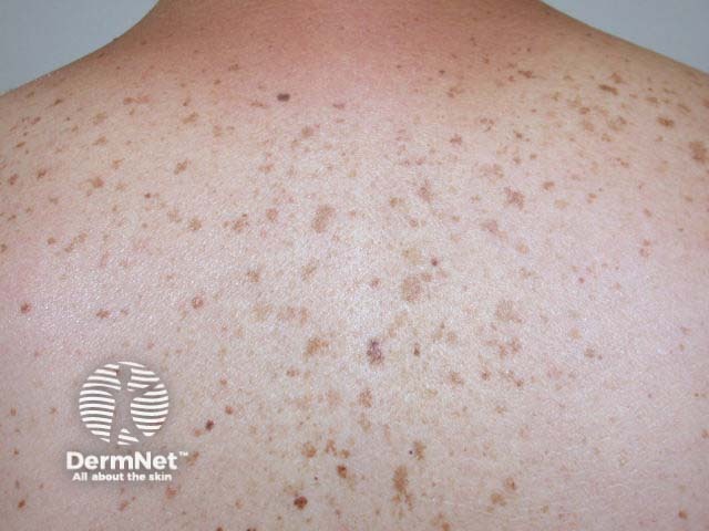 Multiple solar lentigines on a sun-damaged back