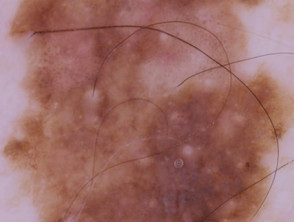 Superficial spreading melanoma, Breslow 0.3mm, nonpolarised dermoscopy view
