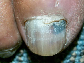Subungual haematoma, toenail