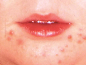 Perioral acne