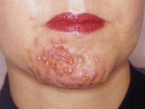 pyoderma faciale acne rosacea fulminans disorder follicular treatment dermnetnz