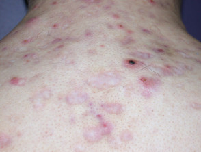 Acne affecting the back images