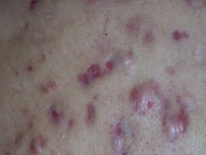 Acne affecting the back images