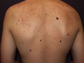 Acne affecting the back images | DermNet NZ