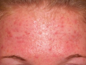 Facial acne images | DermNet NZ