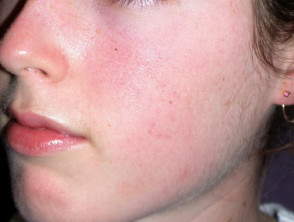 acne-face_1_25