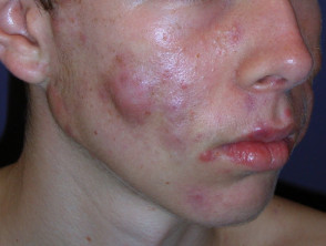 acne-face_1_46