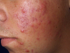 Facial acne