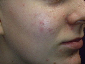 acne-face_3_20
