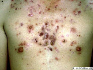 Nodulocystic acne