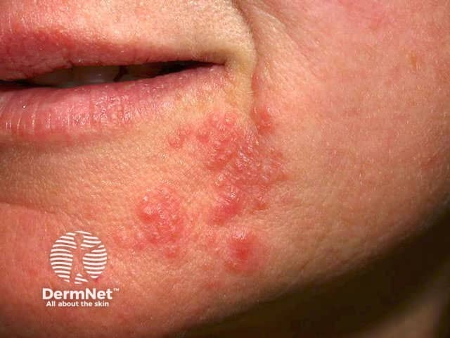 Perioral dermatitis