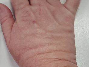 Acral persistent papular mucinosis