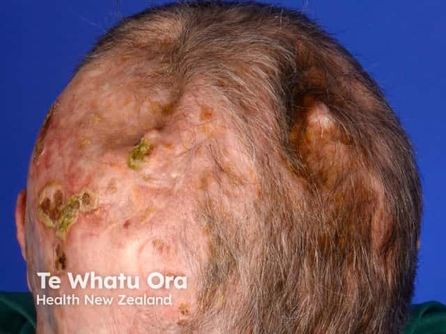 Scarring from surgeries to many basal cell carcinomas in basal cell naevus syndrome