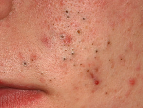 Comedonal acne