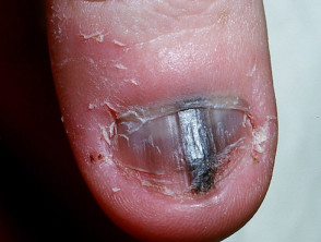 Acral lentiginous melanoma of the nail unit