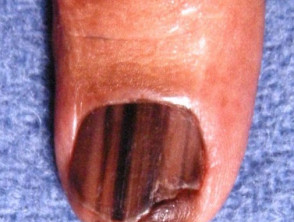 Acral lentiginous melanoma of the nail unit
